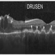Retina Disorders Classification via OCT Scan: A Comparative Study between Self-Supervised Learning and Transfer Learning