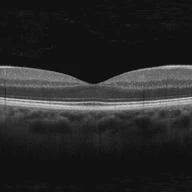 Retina Disorders Classification via OCT Scan: A Comparative Study between Self-Supervised Learning and Transfer Learning
